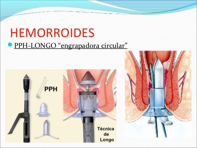 hemorroidectomia tecnica quirurgica